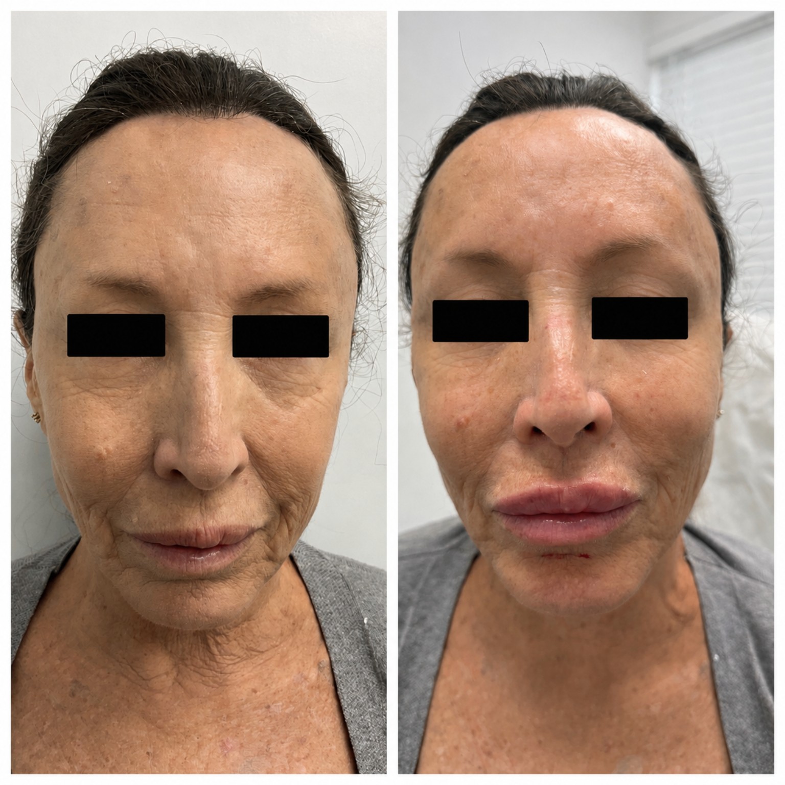 PDO thread lift before and after, front view with eyes obscured in the supplied image