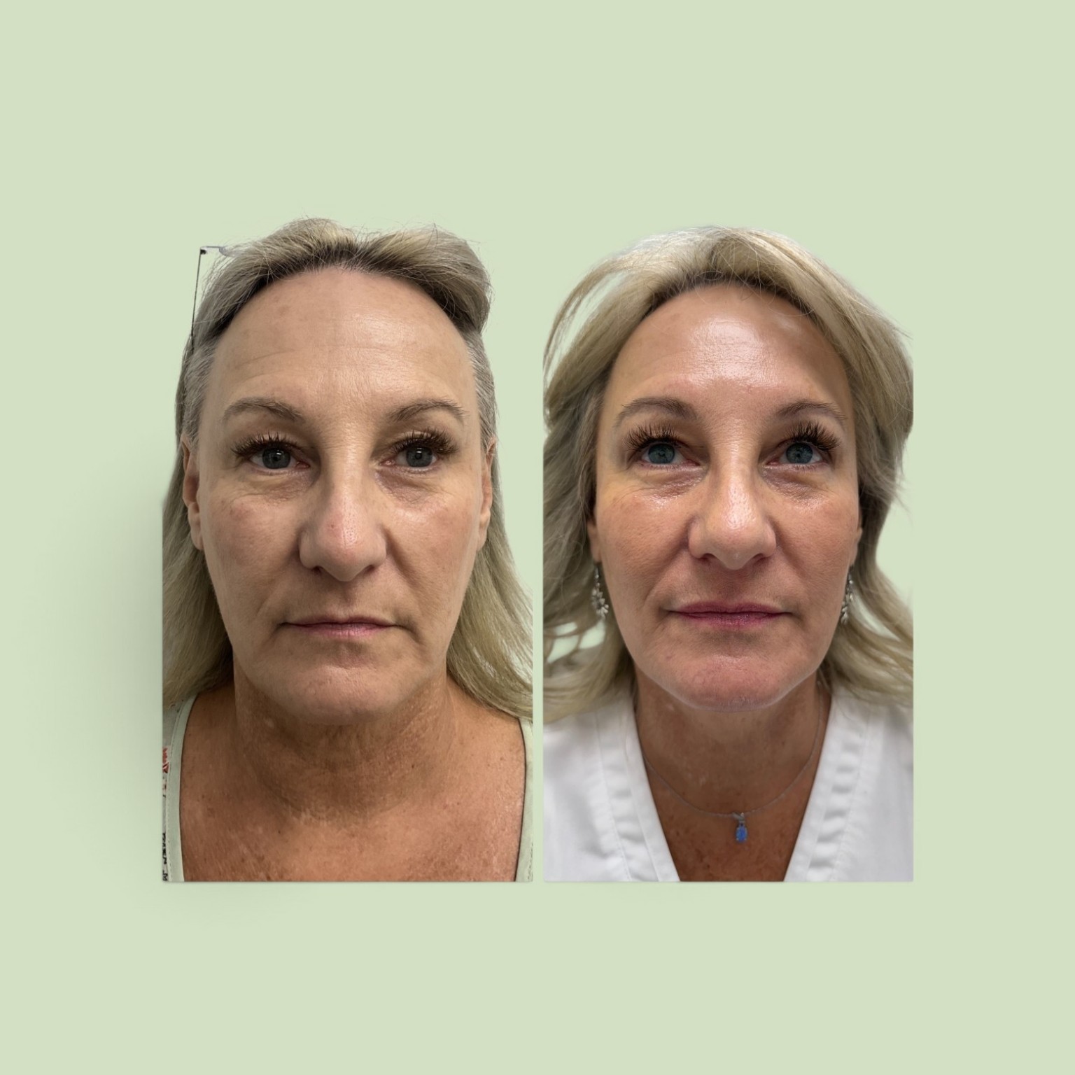 PDO thread lift before and after, front view showing face and neck