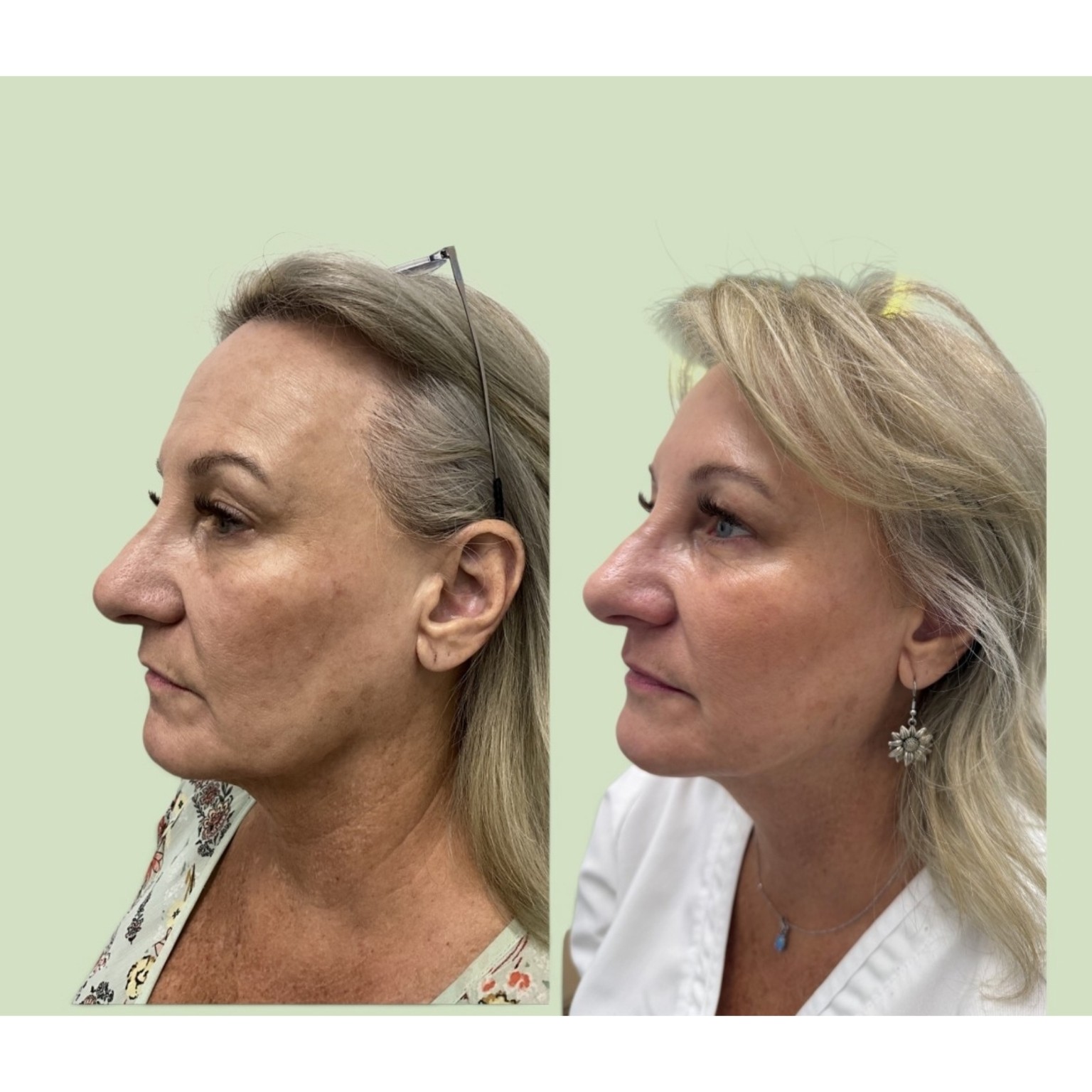 PDO thread lift before and after, side profile showing face and neck