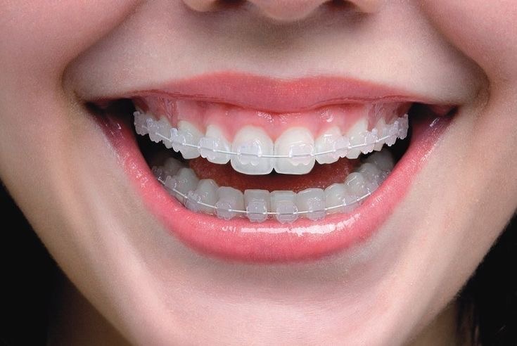Brackets cerámica o zafiro Simetría Dental Studio Machalí