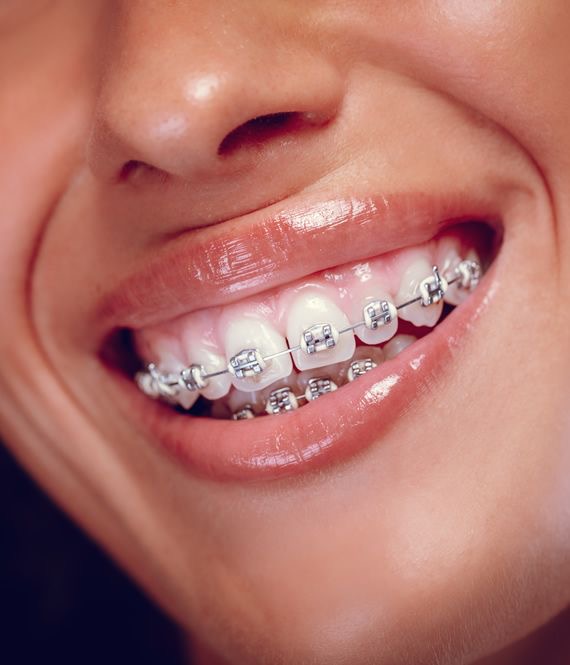 Brackets metálicos Simetría Dental Studio Machalí