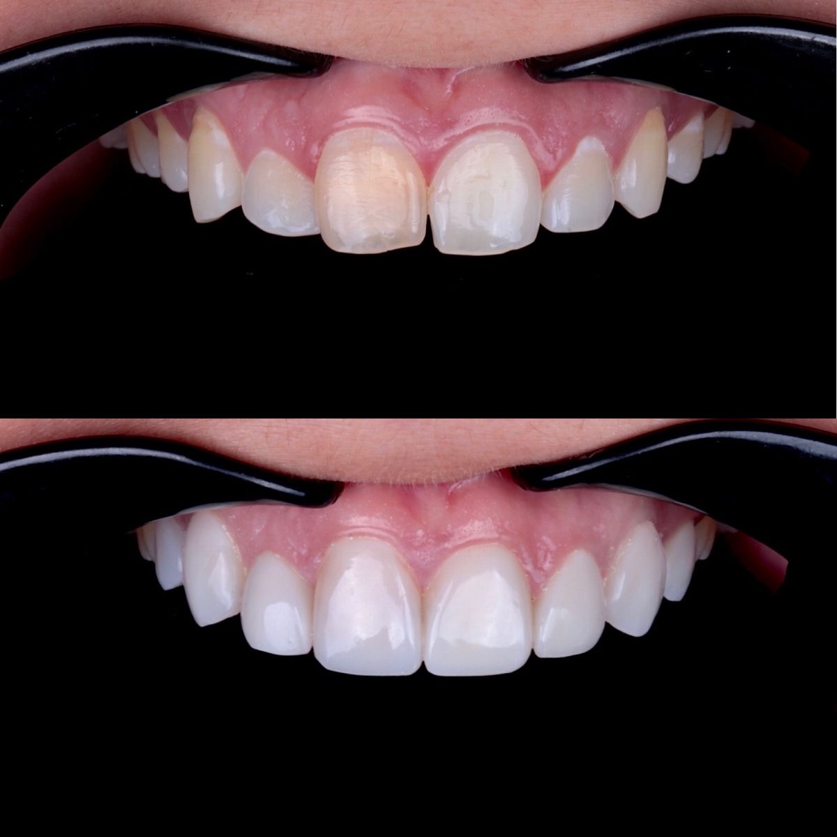 Carillas dentales de resina y cerámica en Machalí — Simetría Dental Studio