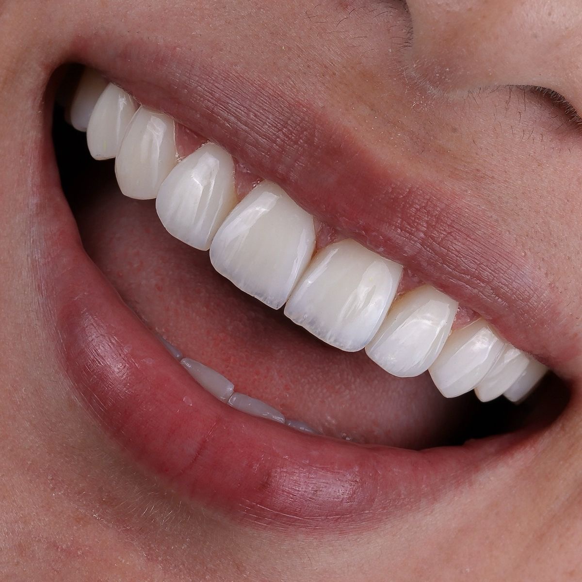 Diseño de sonrisa en Machalí — Simetría Dental Studio