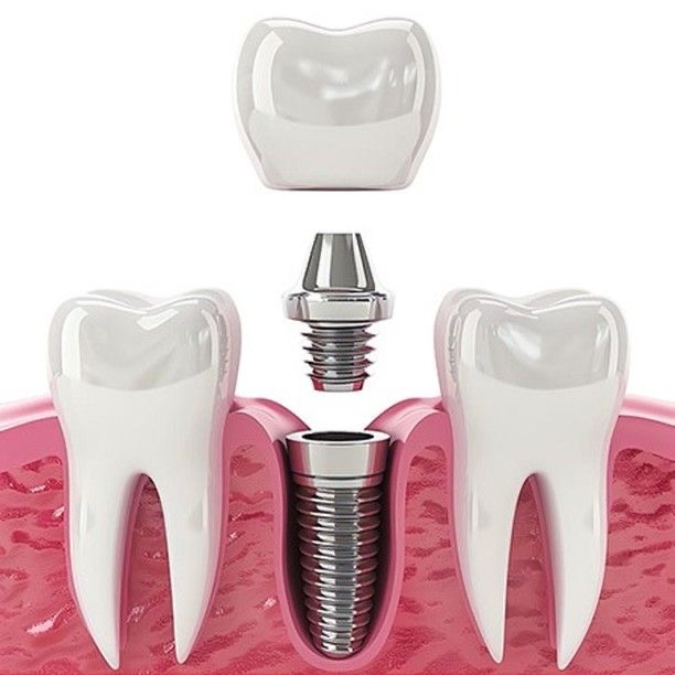 Implantes dentales unitarios en Machalí — Simetría Dental Studio