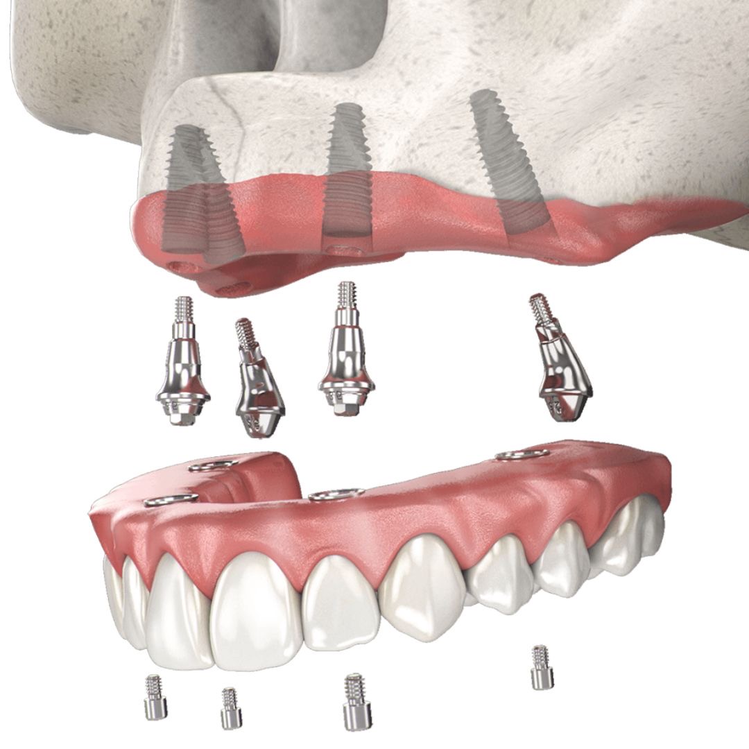 Implantes múltiples en Machalí — Simetría Dental Studio