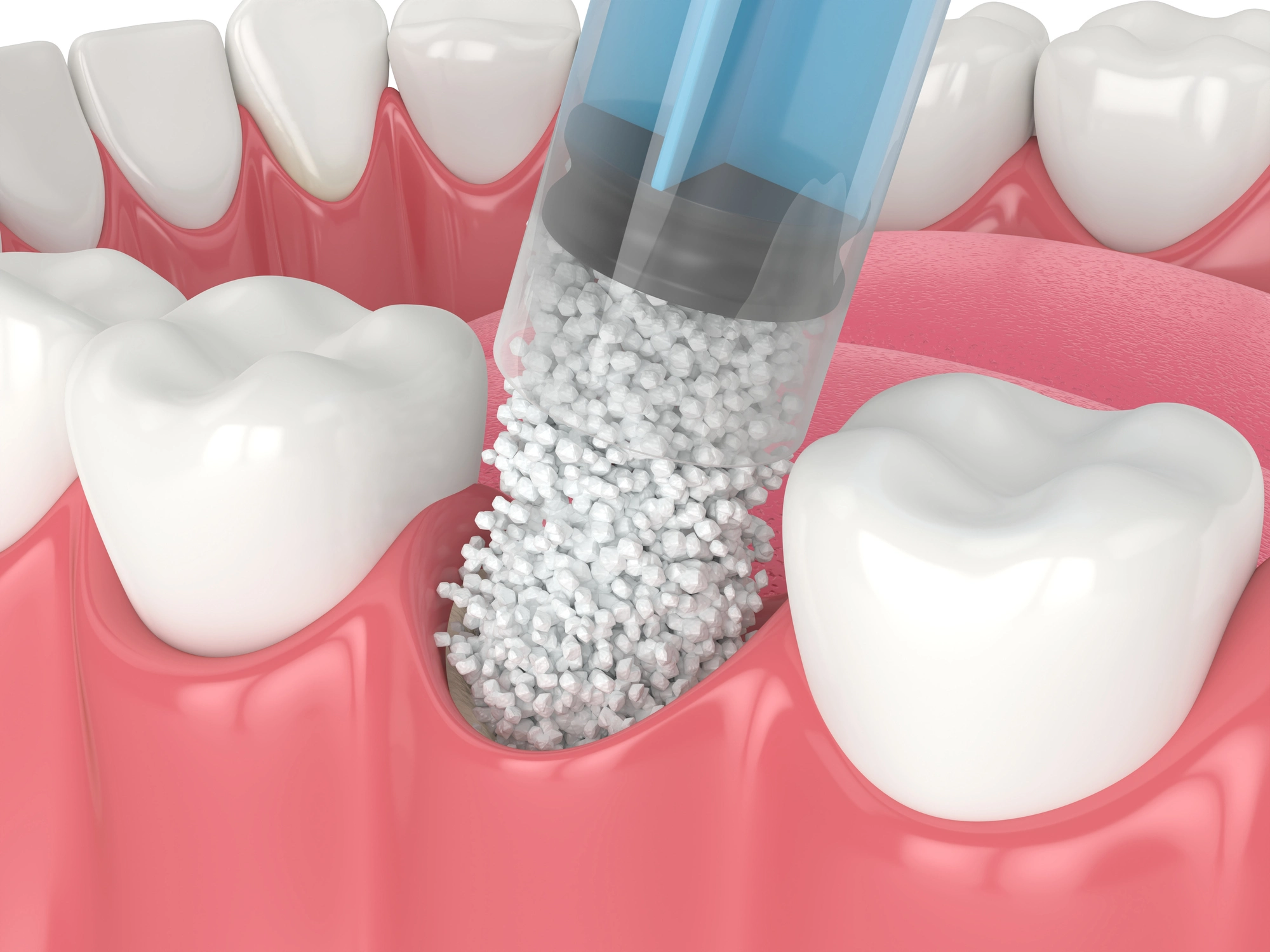Injertos óseos en Machalí — Simetría Dental Studio