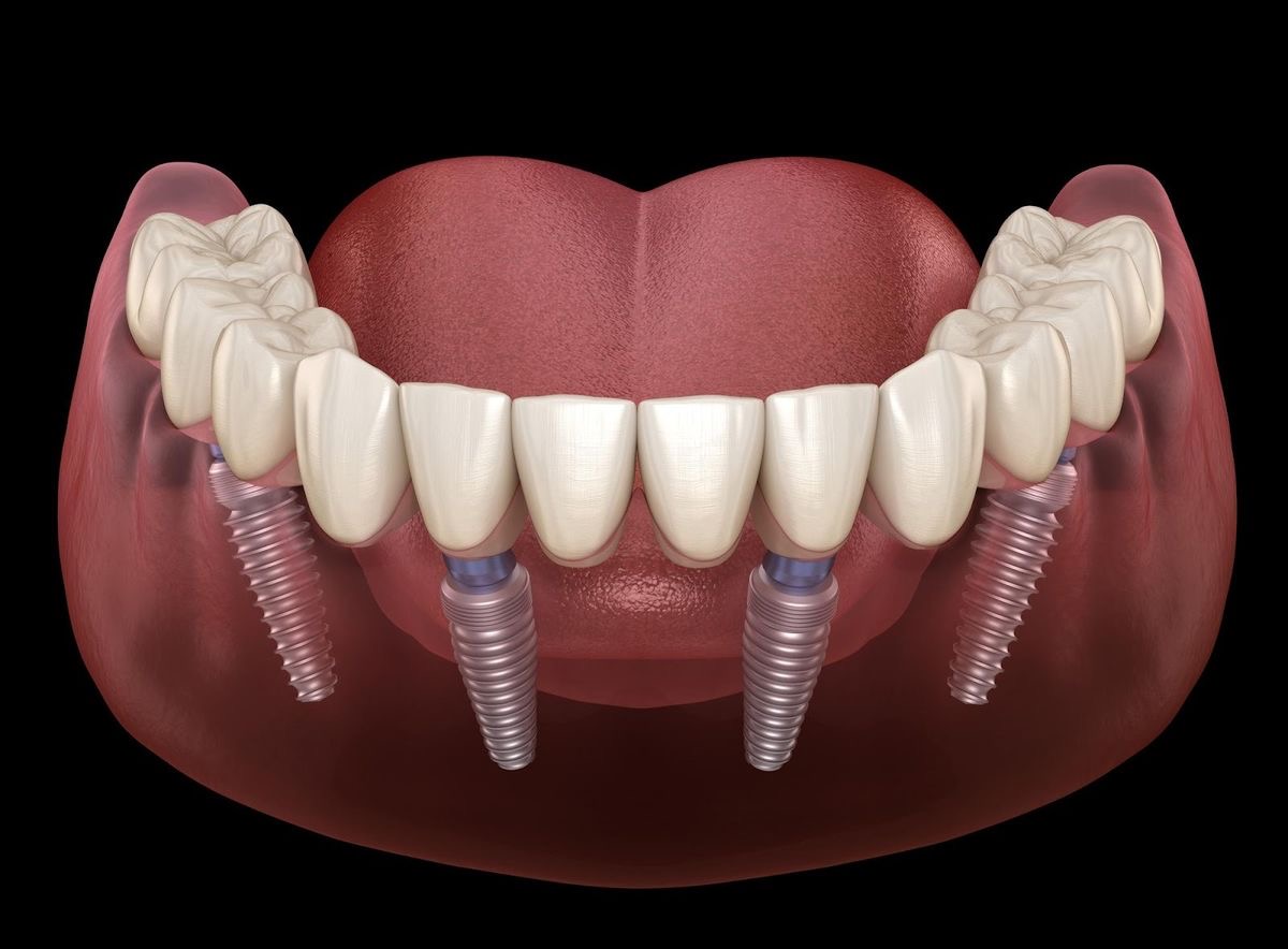 Carga inmediata implantes dentales Machalí — Simetría Dental Studio