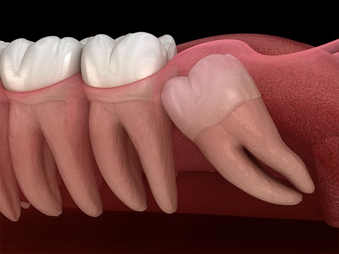 Cirugía terceros molares muelas del juicio Machalí — Simetría Dental Studio