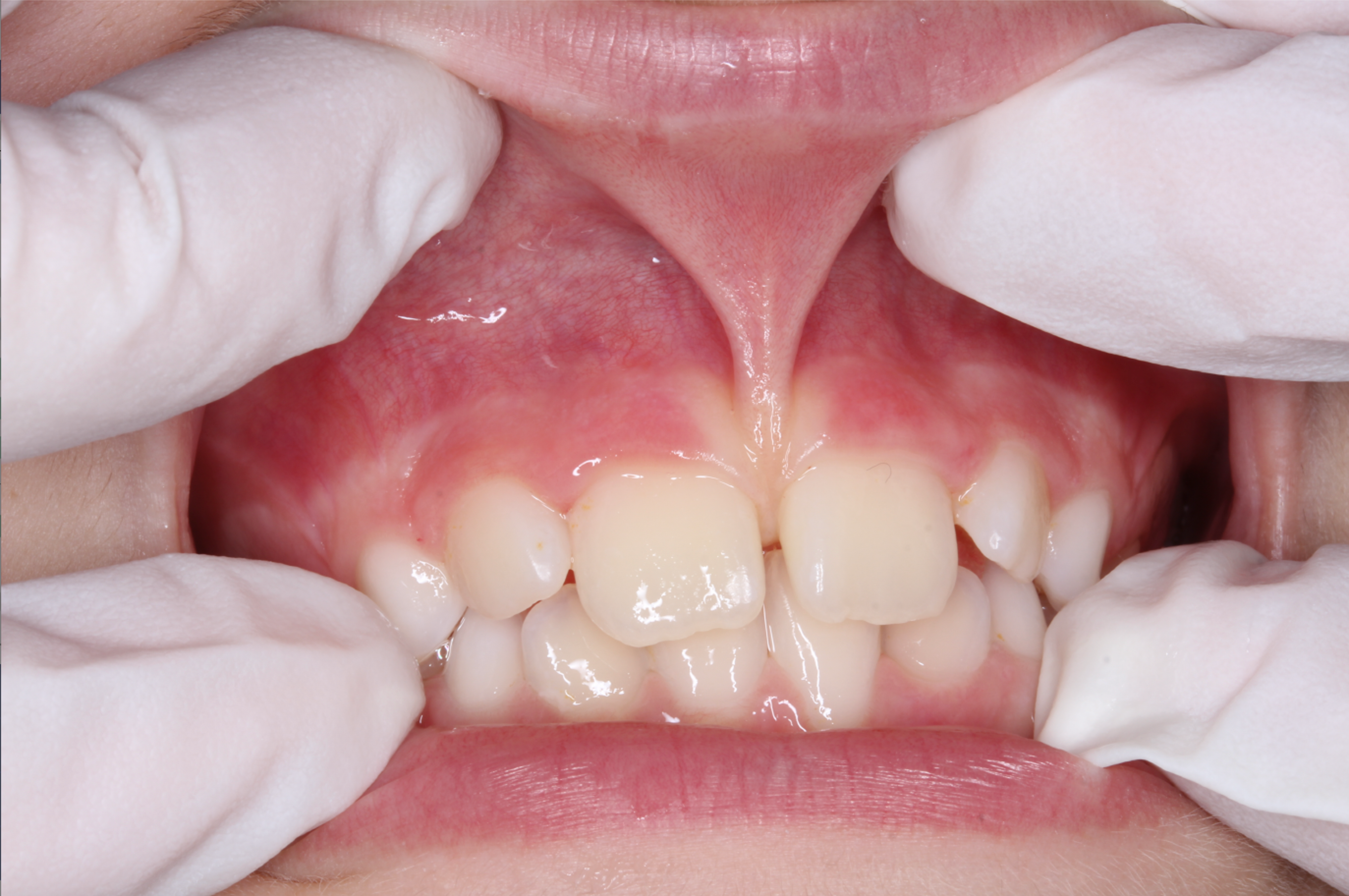 Frenectomía en Machalí — Simetría Dental Studio