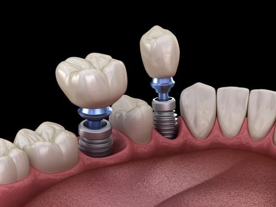 Prótesis fija en Machalí — Simetría Dental Studio