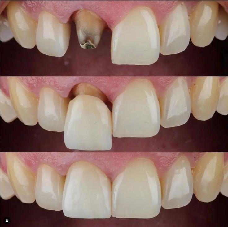 Coronas dentales en Machalí — Simetría Dental Studio