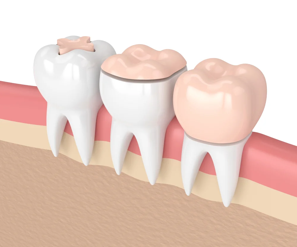 Incrustaciones inlays onlays en Machalí — Simetría Dental Studio
