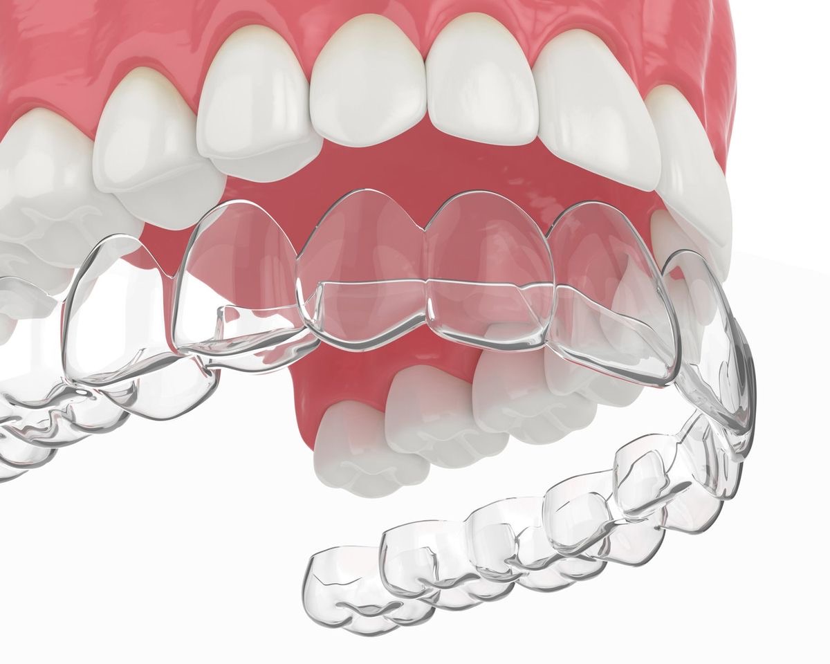 Placas de relajación bruxismo Machalí — Simetría Dental Studio