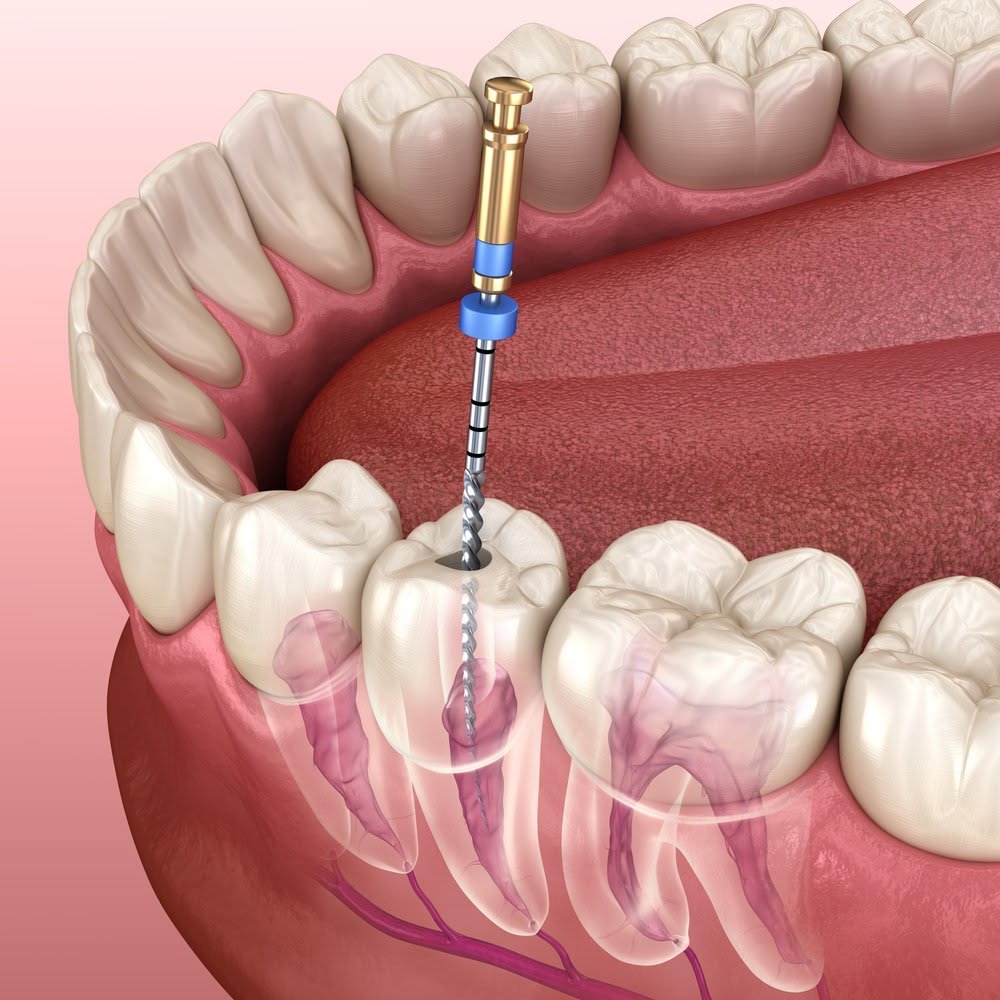 Endodoncia