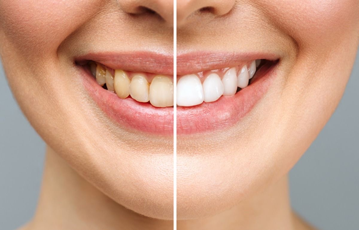 Blanqueamiento Philips Zoom Dental Vitacura