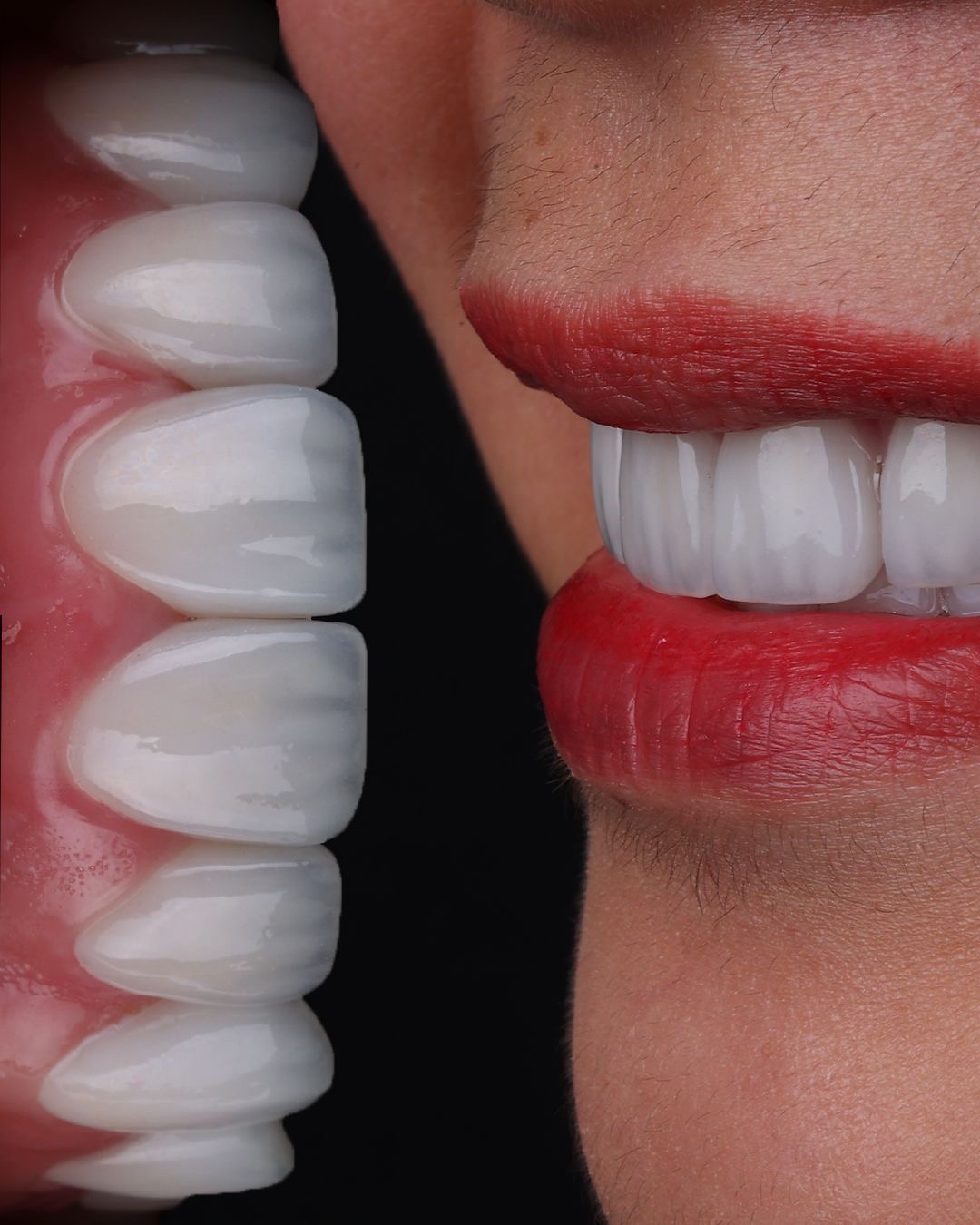 Carillas Dentales Dental Vitacura