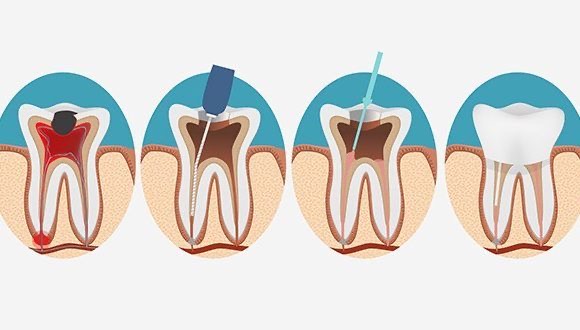 Endodoncia Dental Vitacura