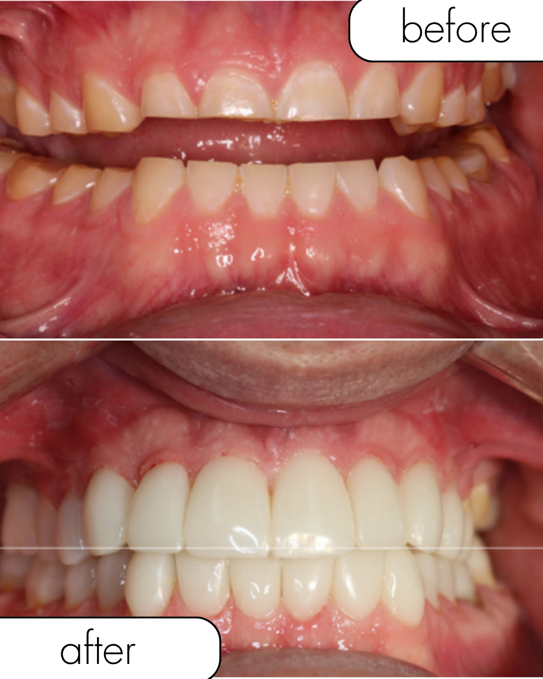 Before and after dental implant case 3