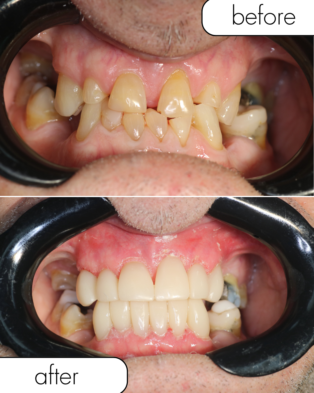 Before and after dental implant case 1