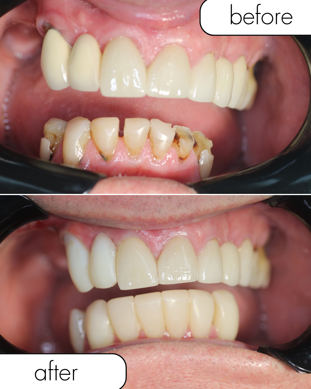Before and after dental implant case 2