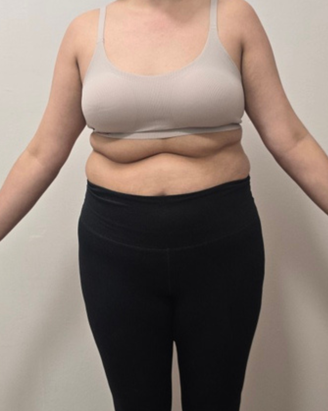 Antes · T-SHAPE 360