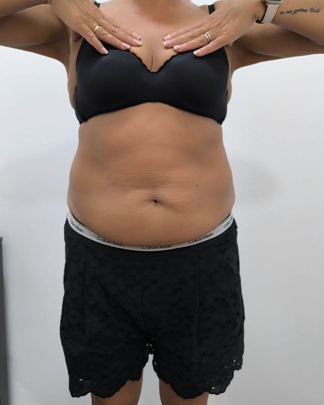 Antes · T-SHAPE 360