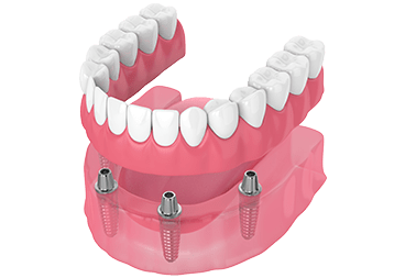 High-quality Dental Implants