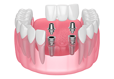 Effective Orthodontic Solutions