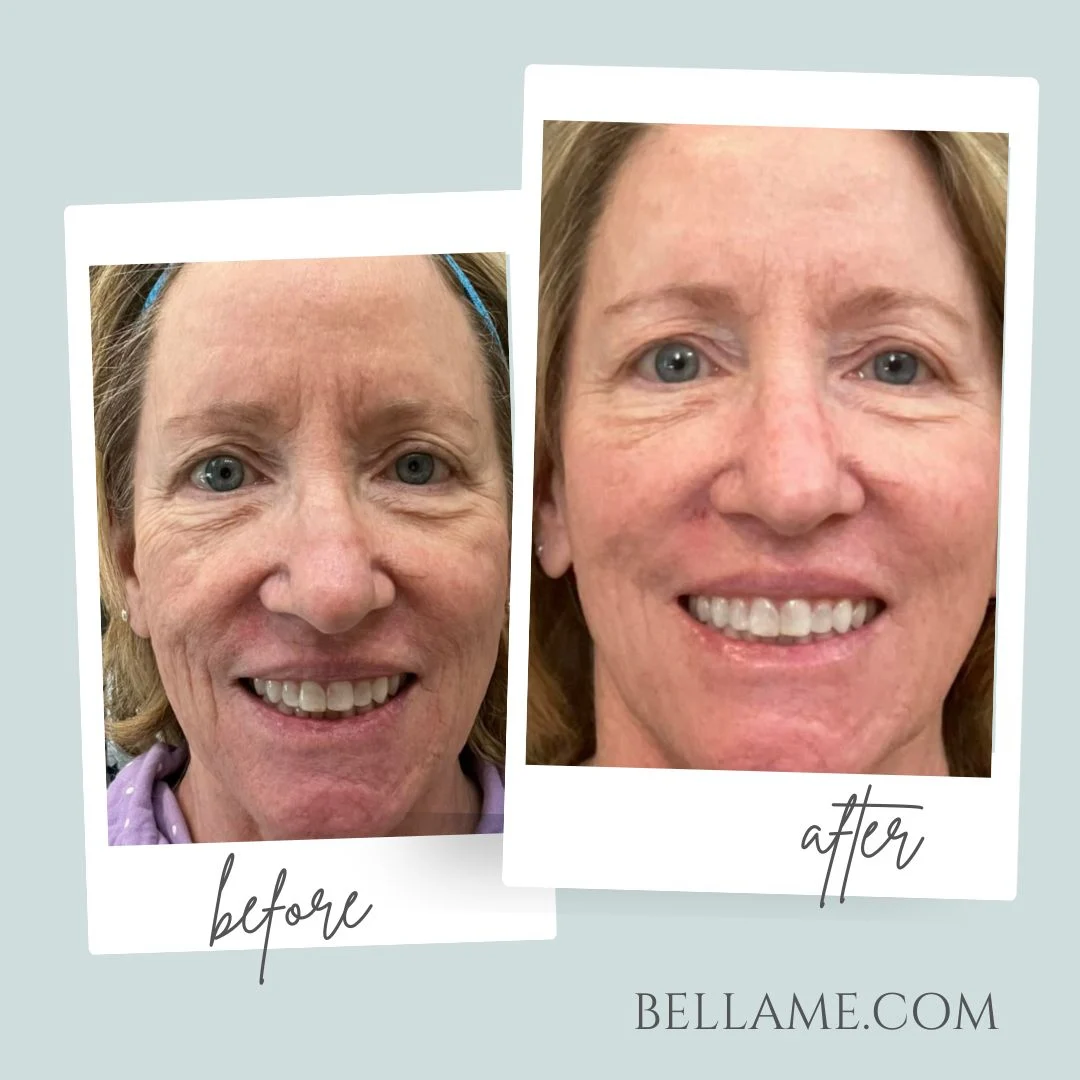 Before and After Results