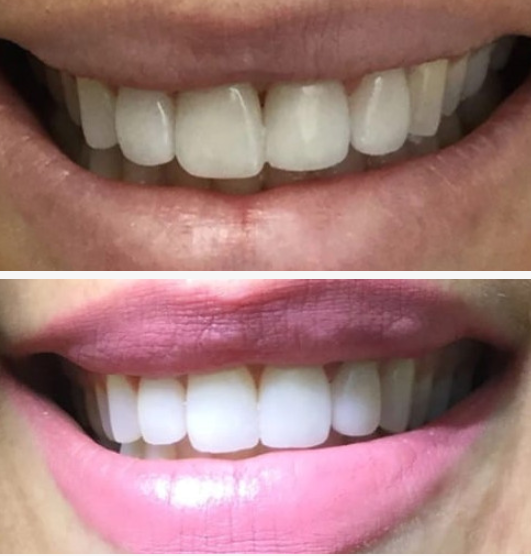 Dental implant patient smile transformation