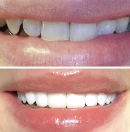 Before and after full mouth reconstruction