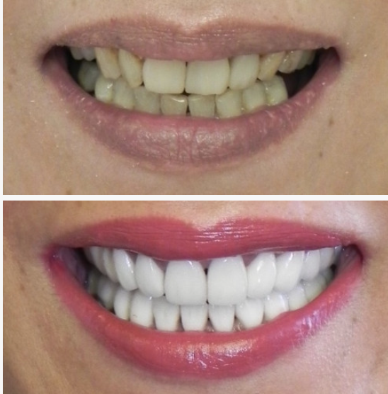 Full arch dental implants consultation in Miami for patients with missing teeth or dentures