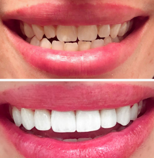 Before and after full mouth reconstruction