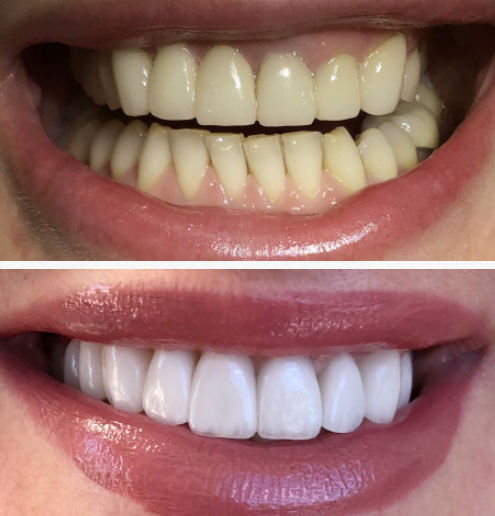 Before and after full mouth reconstruction