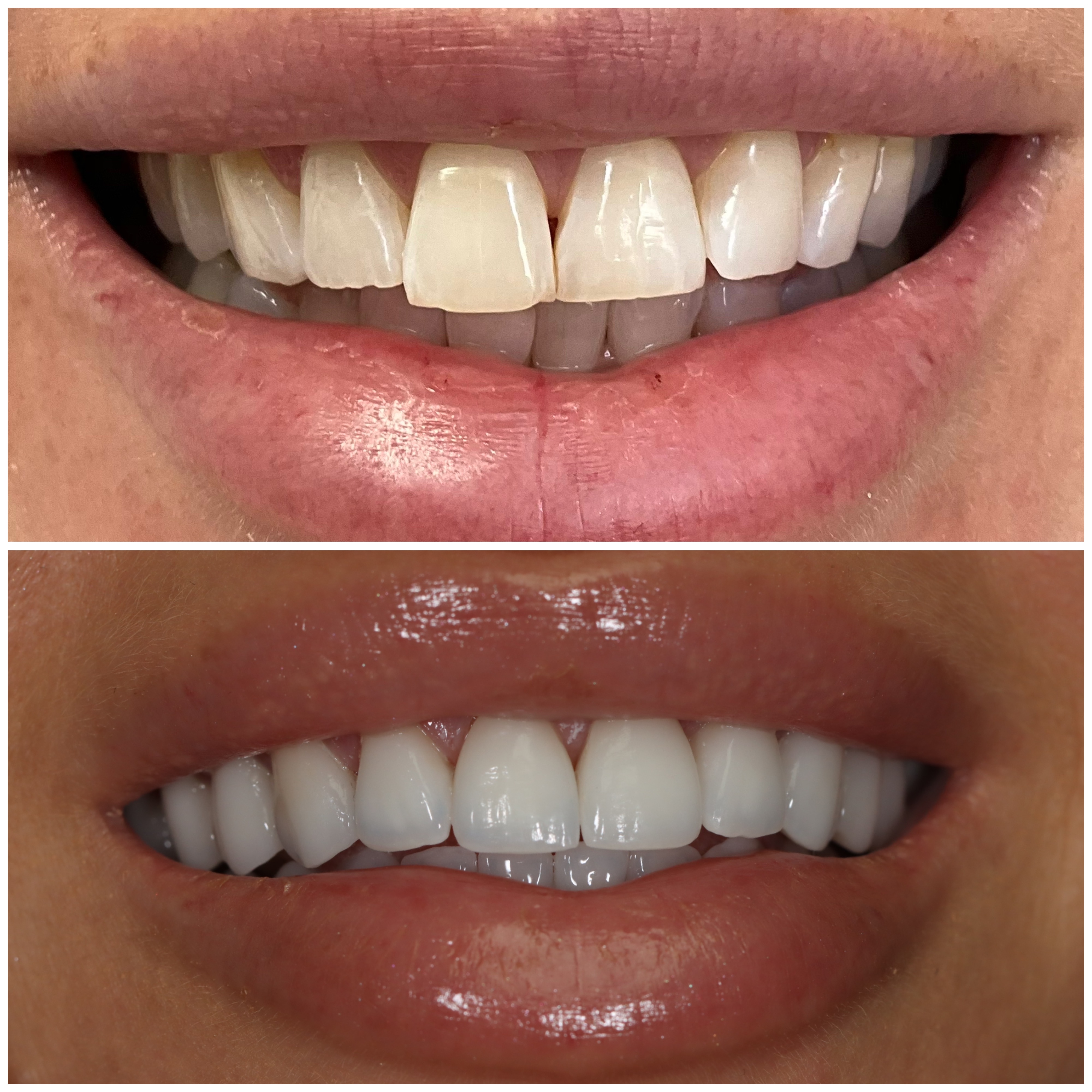 Before and after full mouth reconstruction