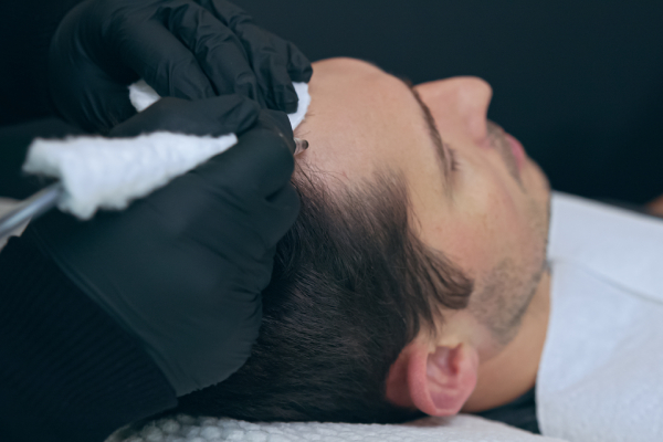 Scalp MicroPigmentation