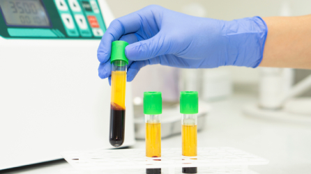 PRP Platelet Rich Plasma