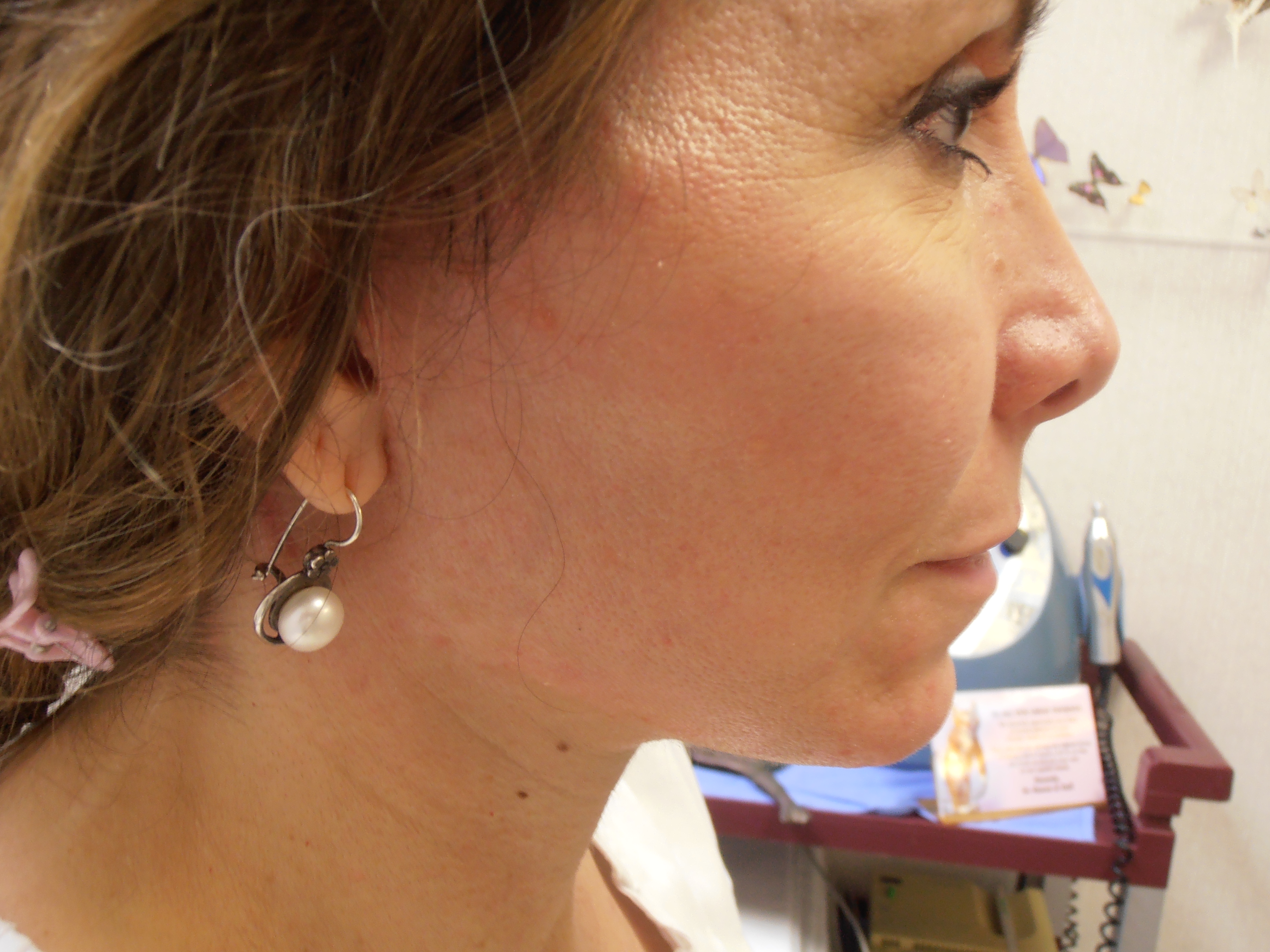 After face and neck lift, patient 10