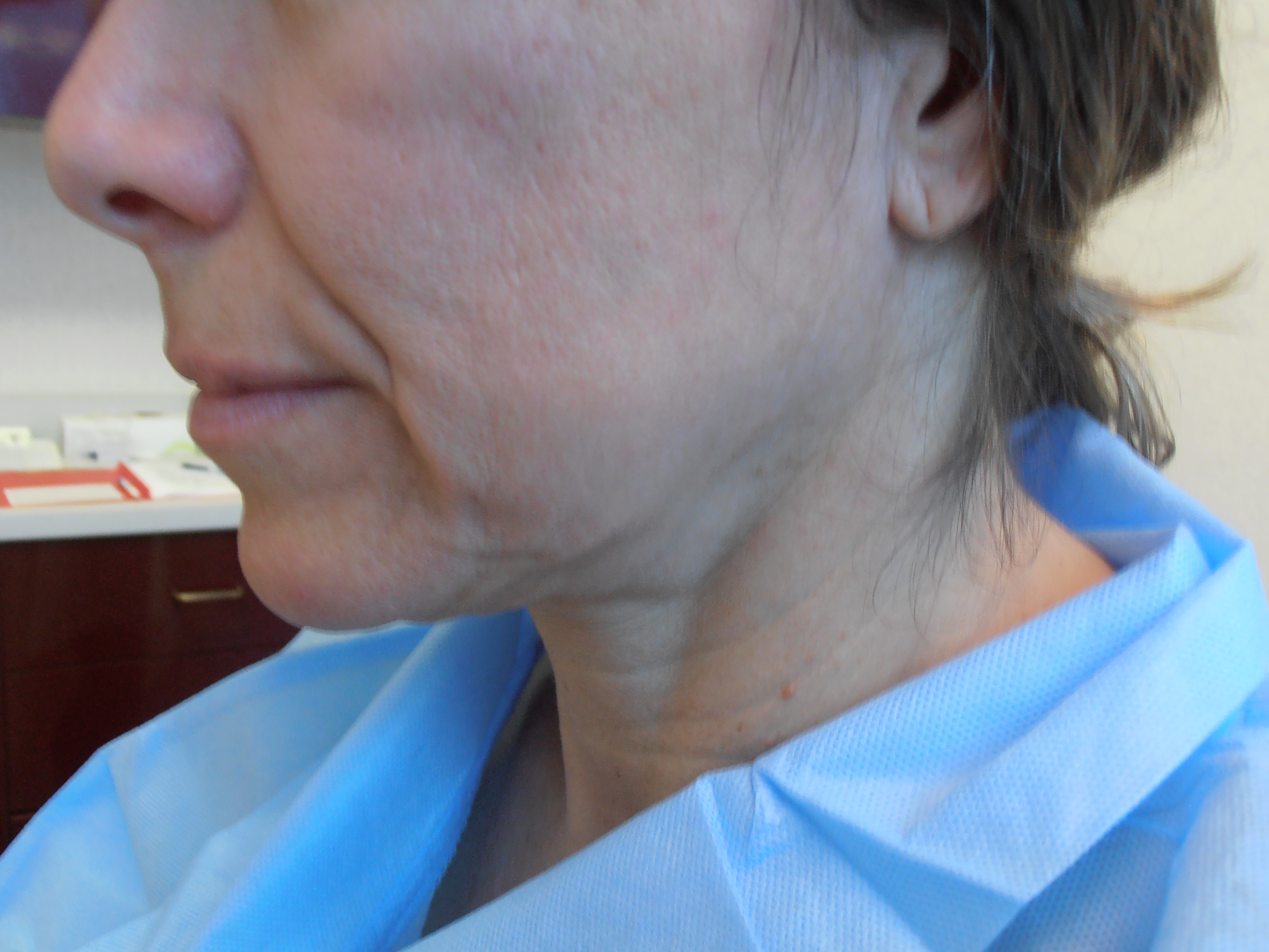 Before face and neck lift, patient 11