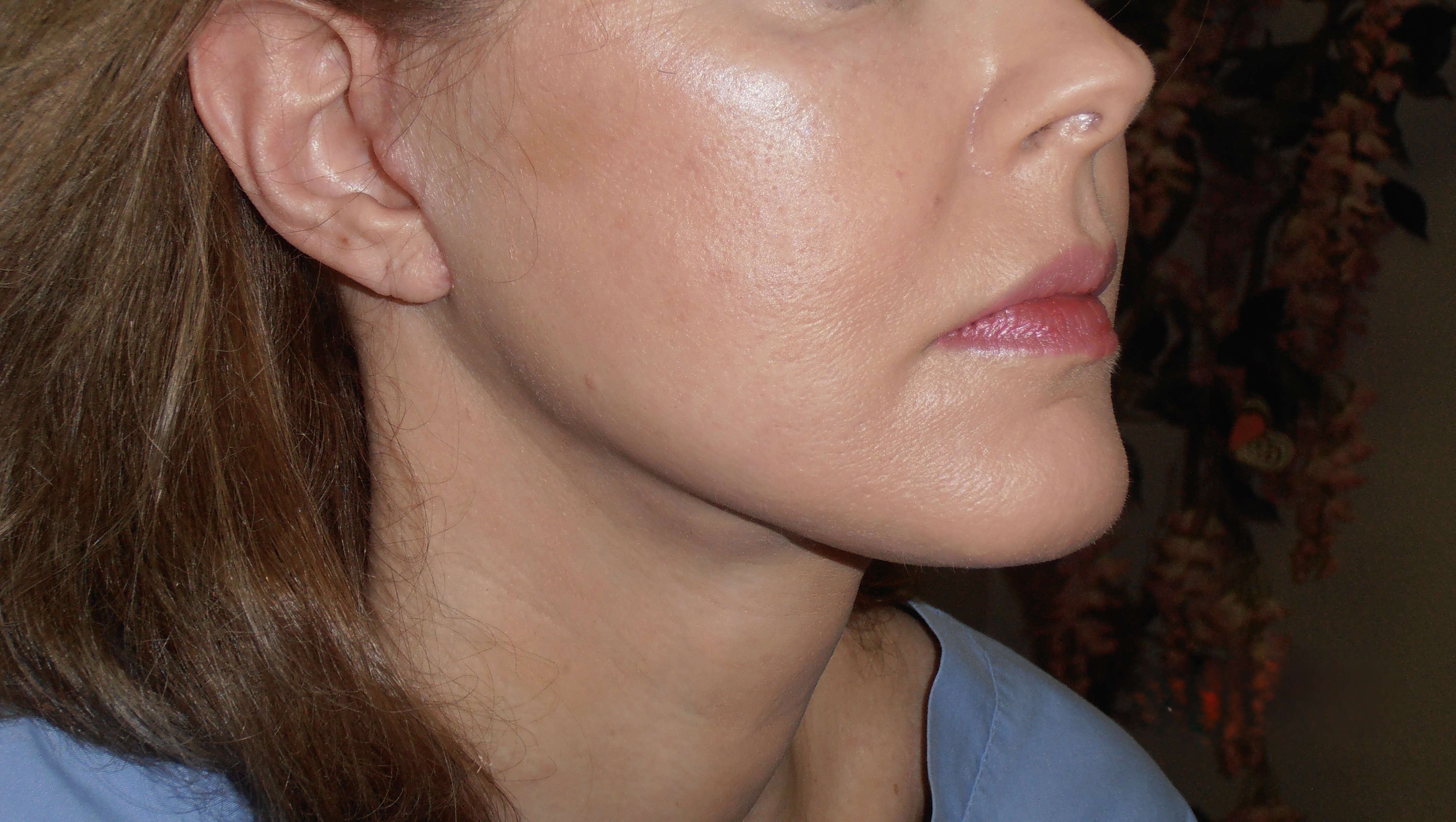 After face and neck lift, patient 3