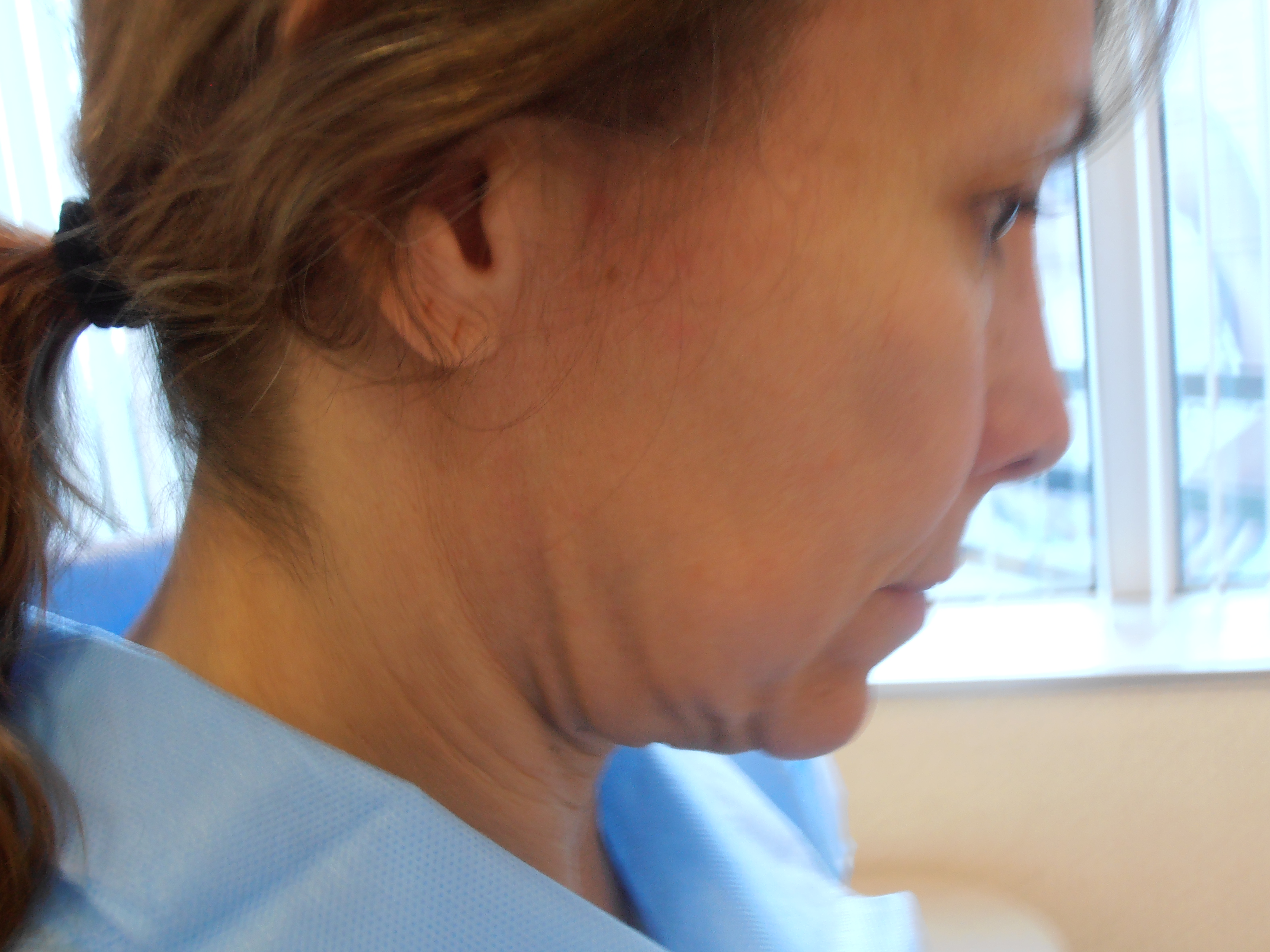 Before face and neck lift, patient 10