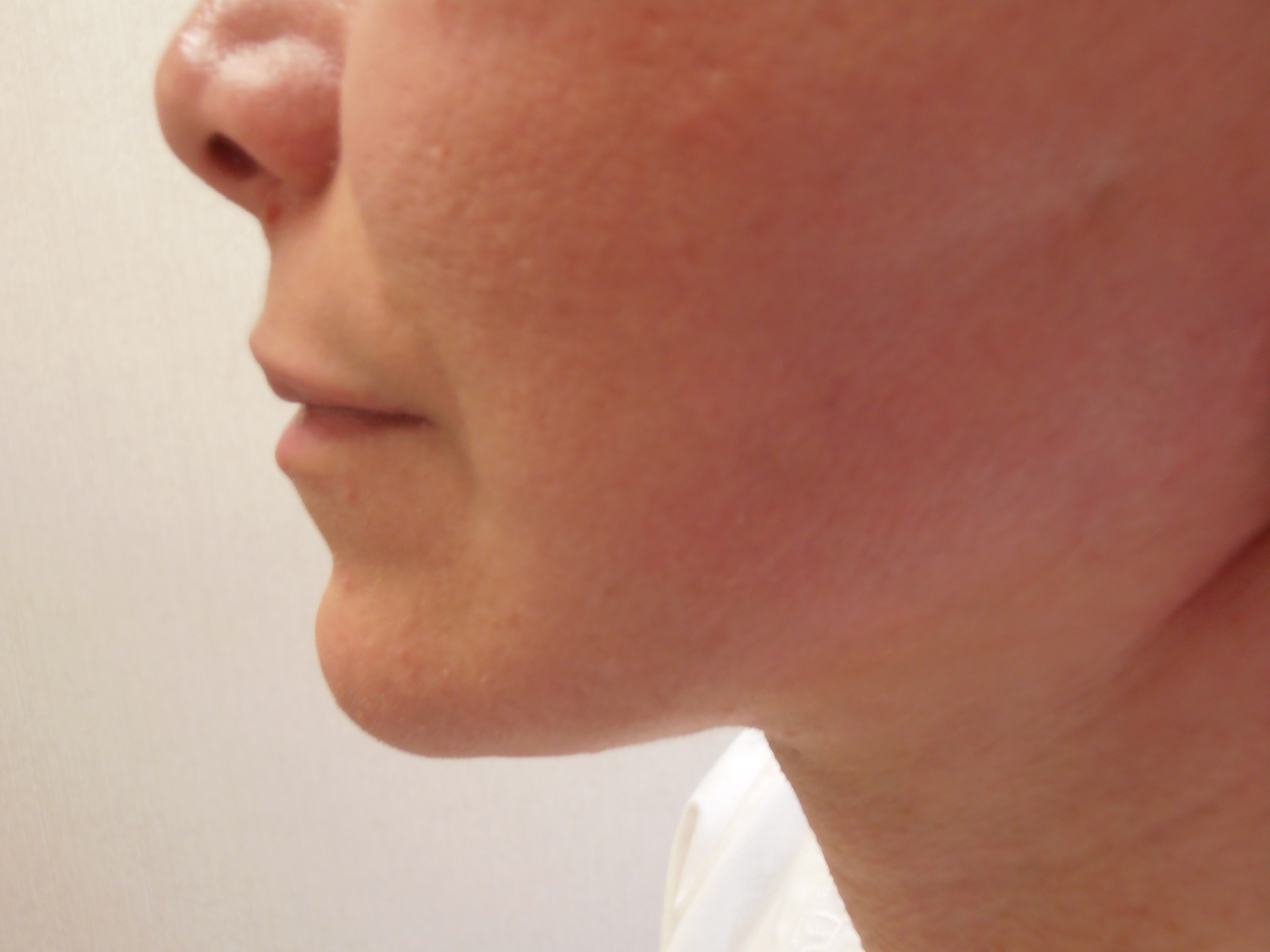 After face and neck lift, patient 11