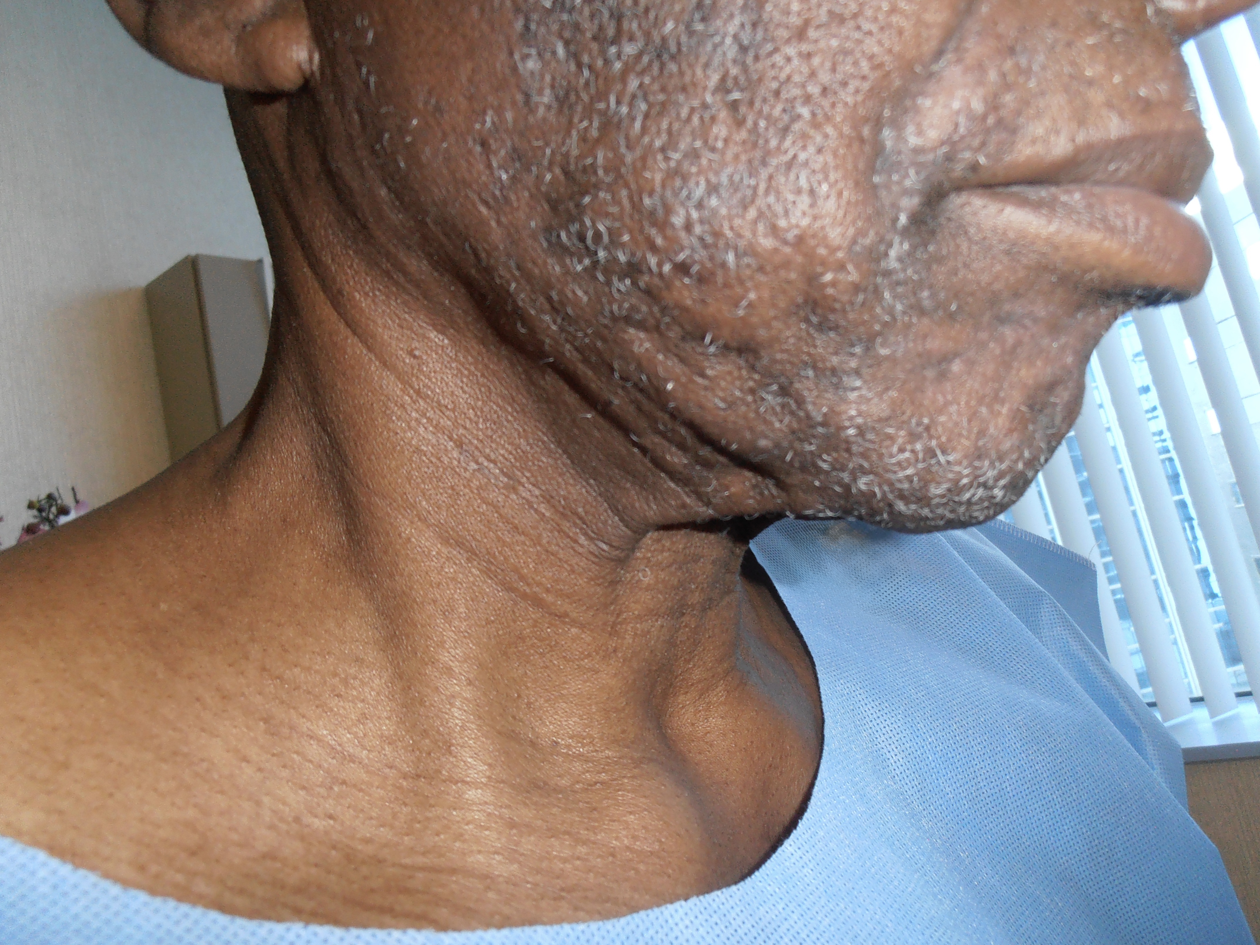 Before face and neck lift, patient 22