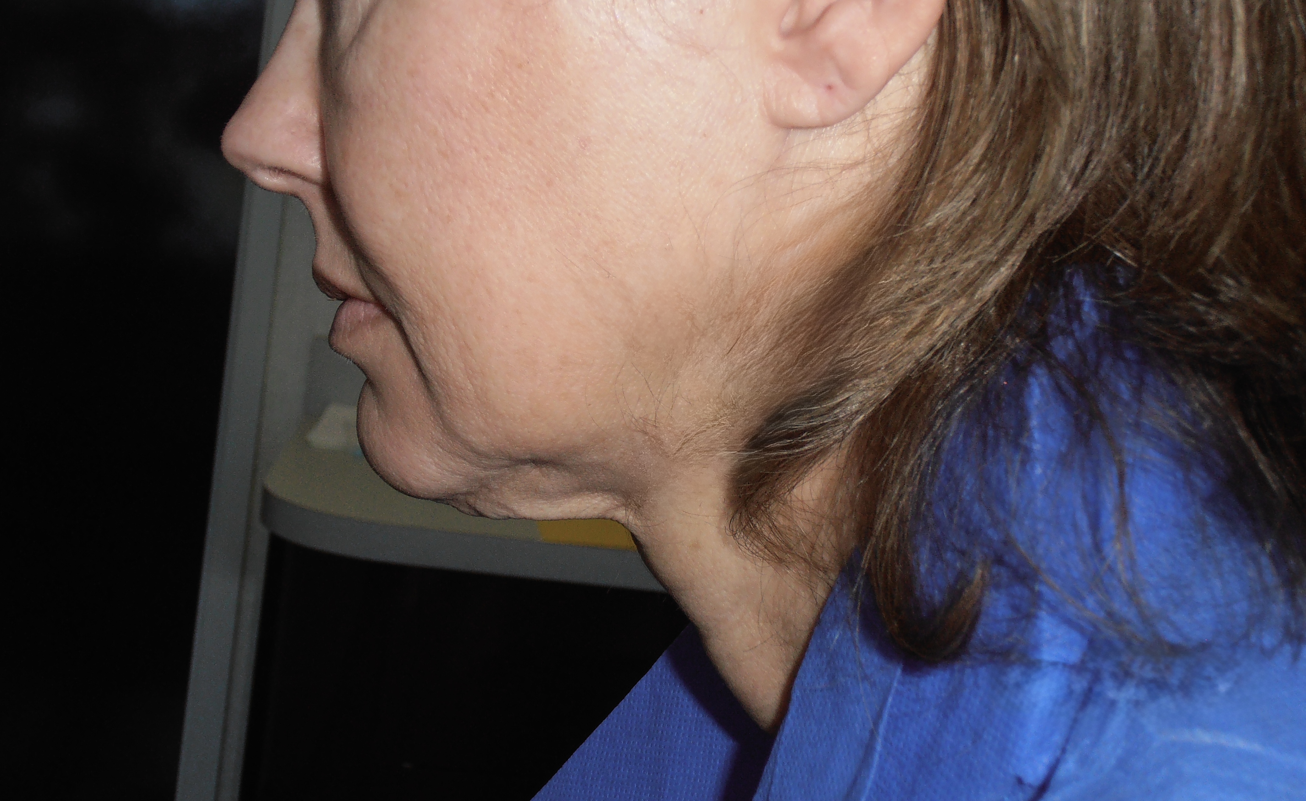 Before face and neck lift, patient 21
