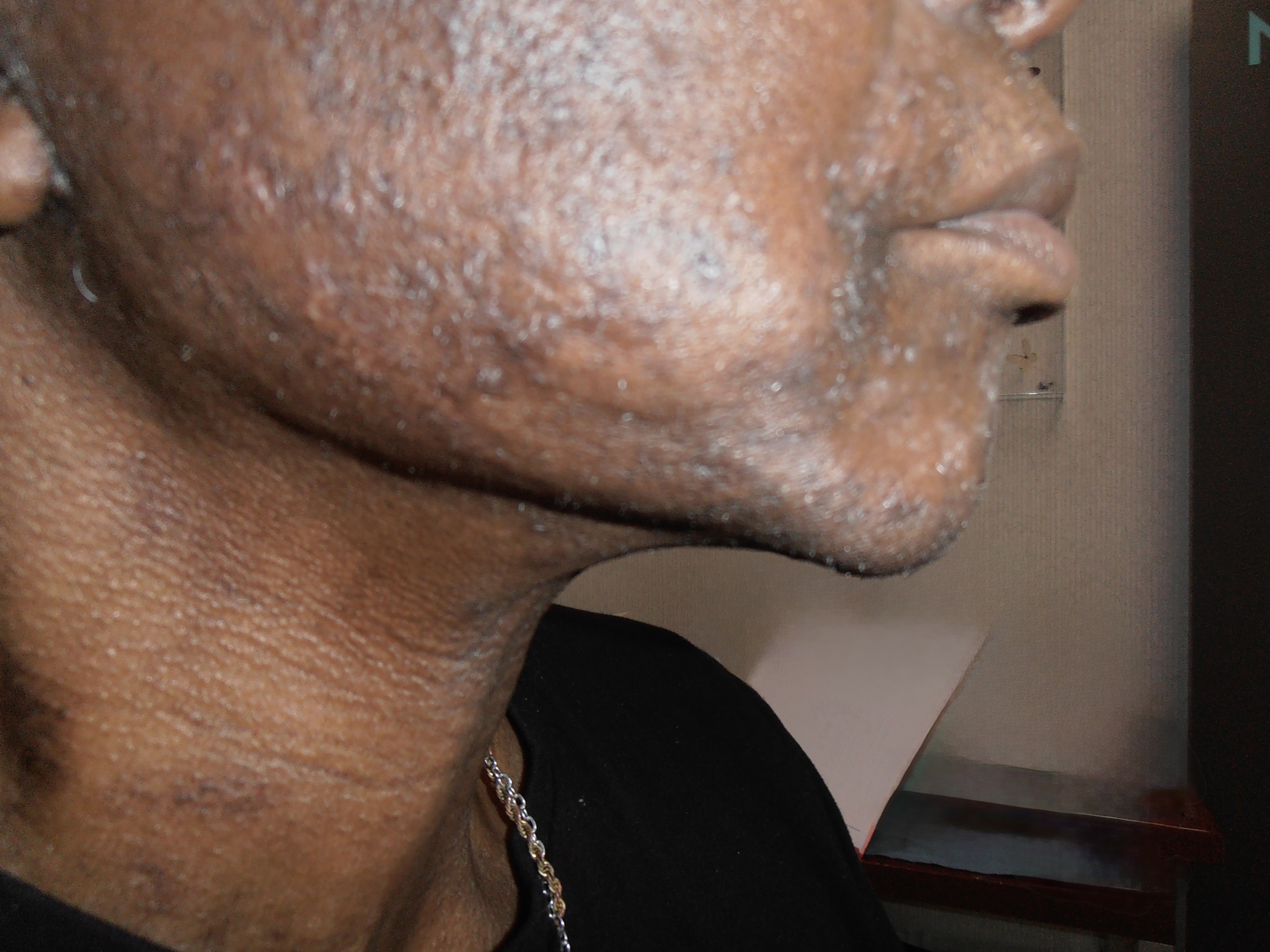 After face and neck lift, patient 22