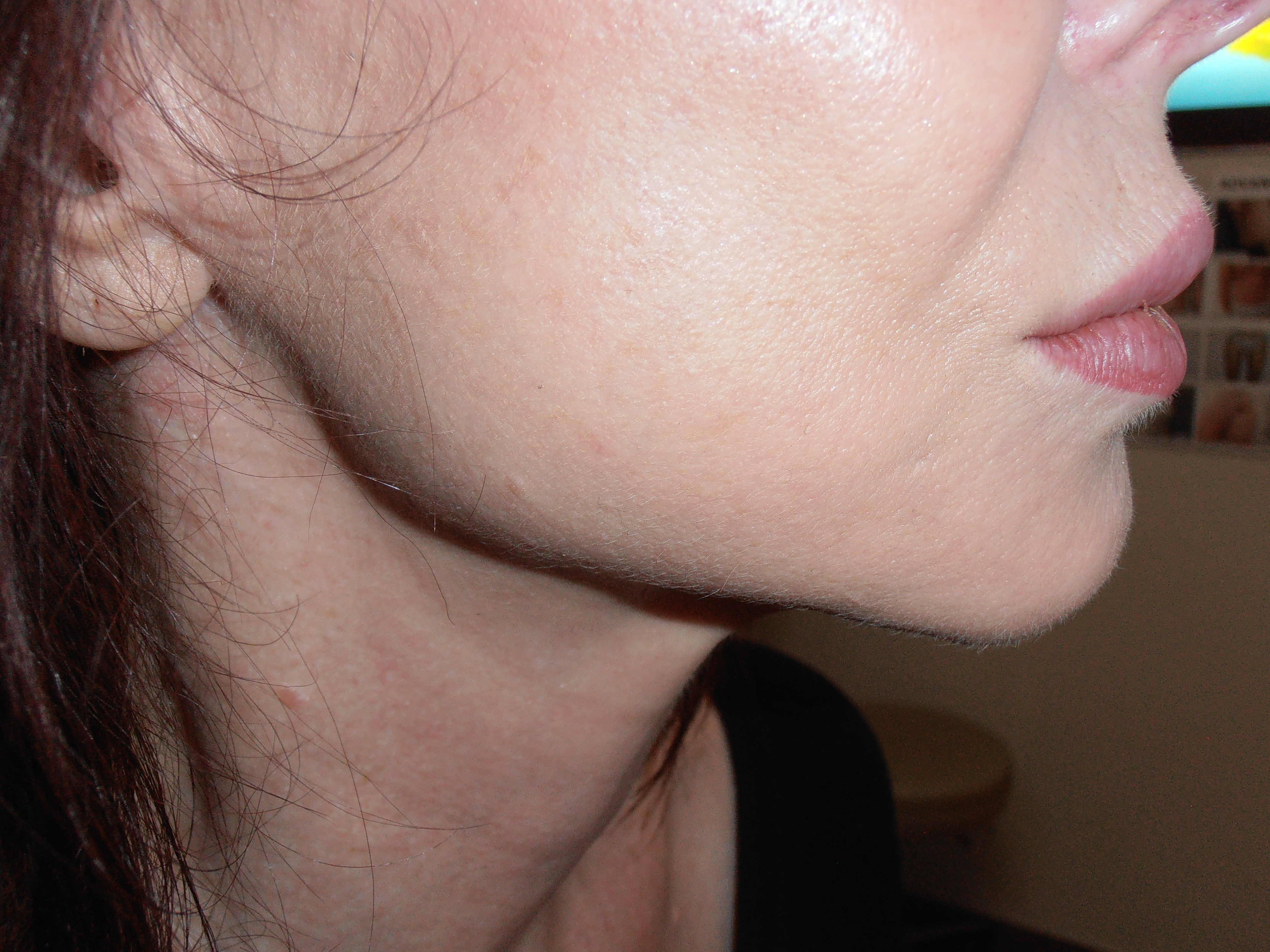 After face and neck lift, patient 19