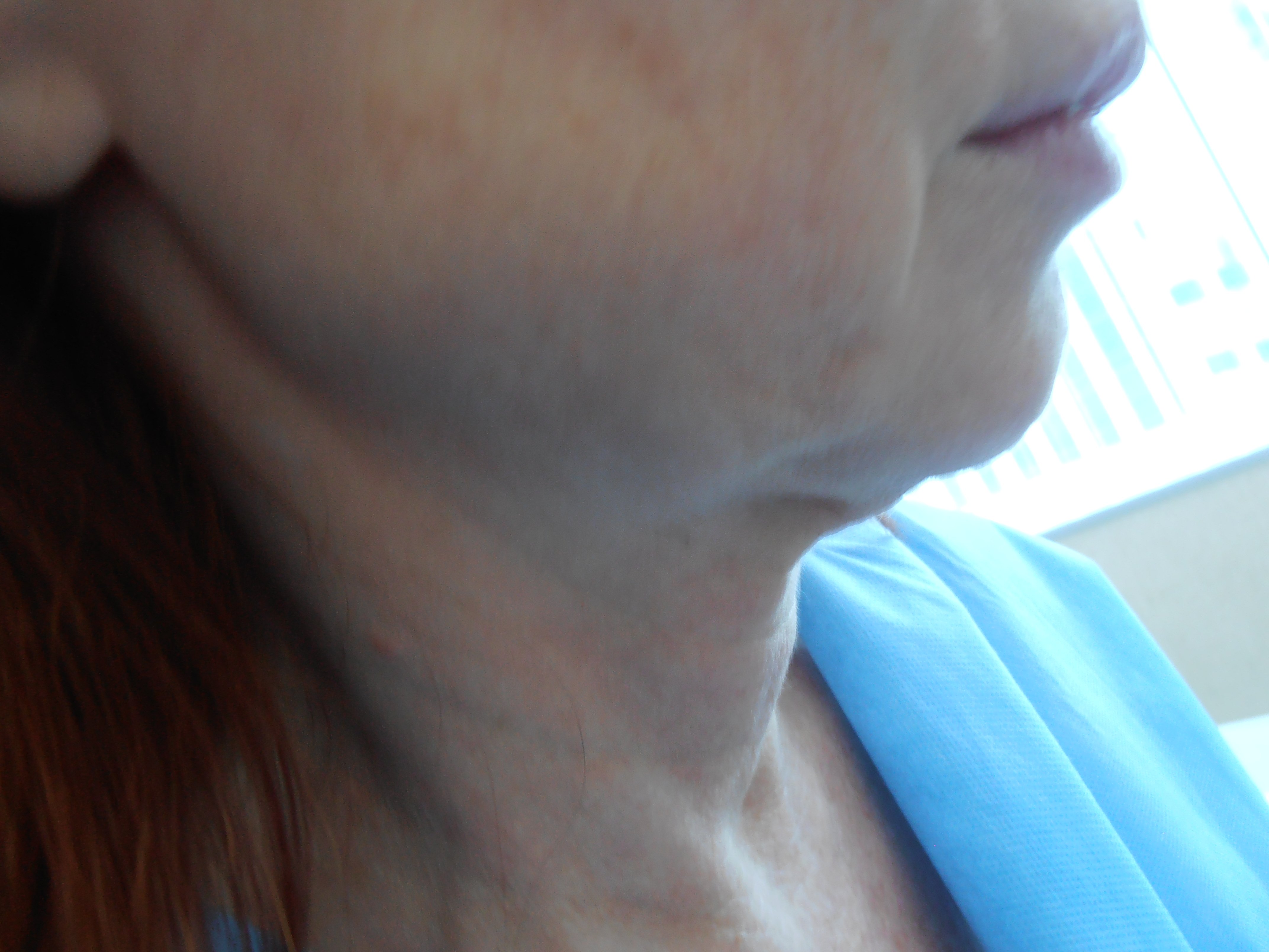 Before face and neck lift, patient 19