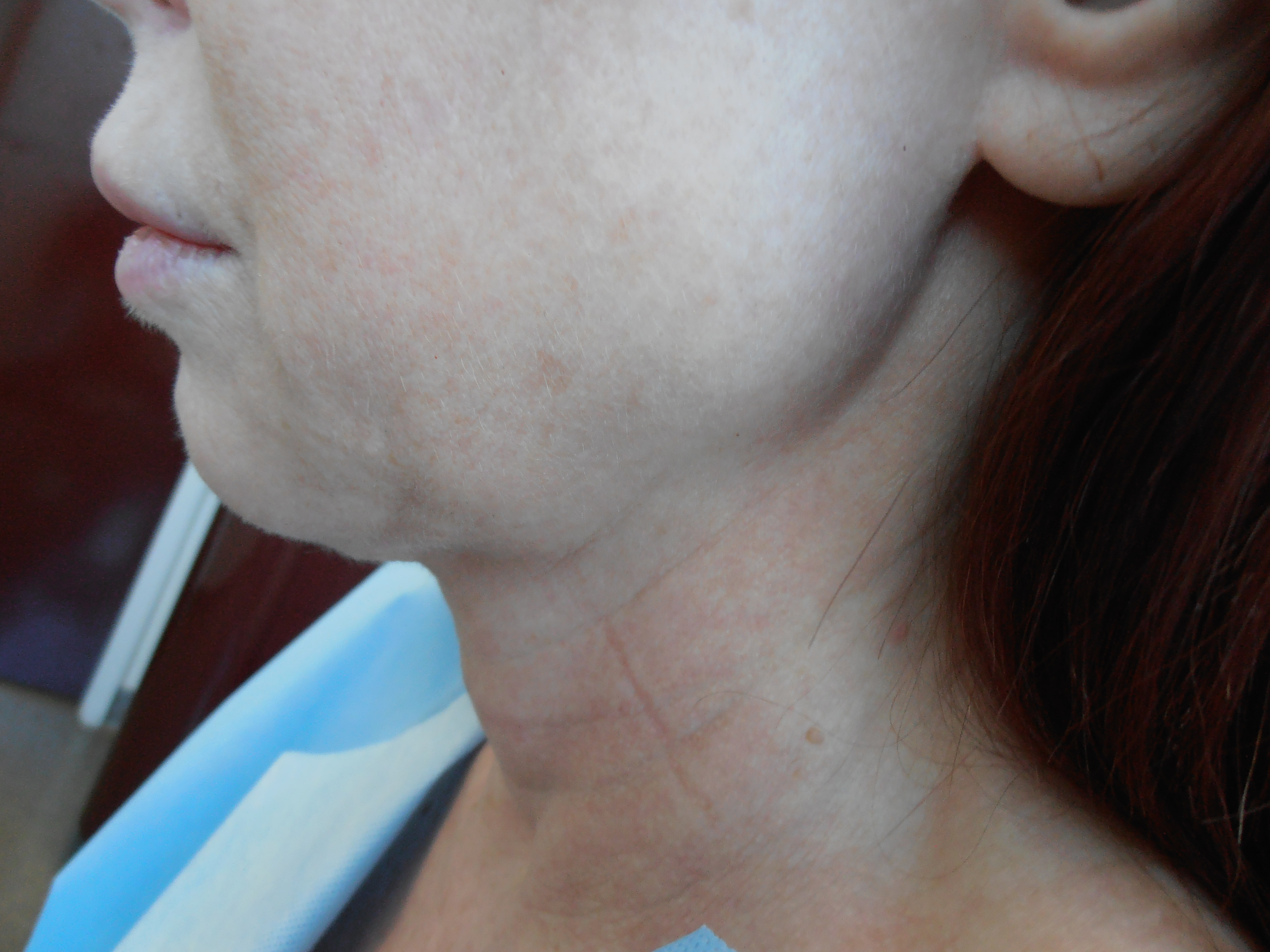 Before face and neck lift, patient 20
