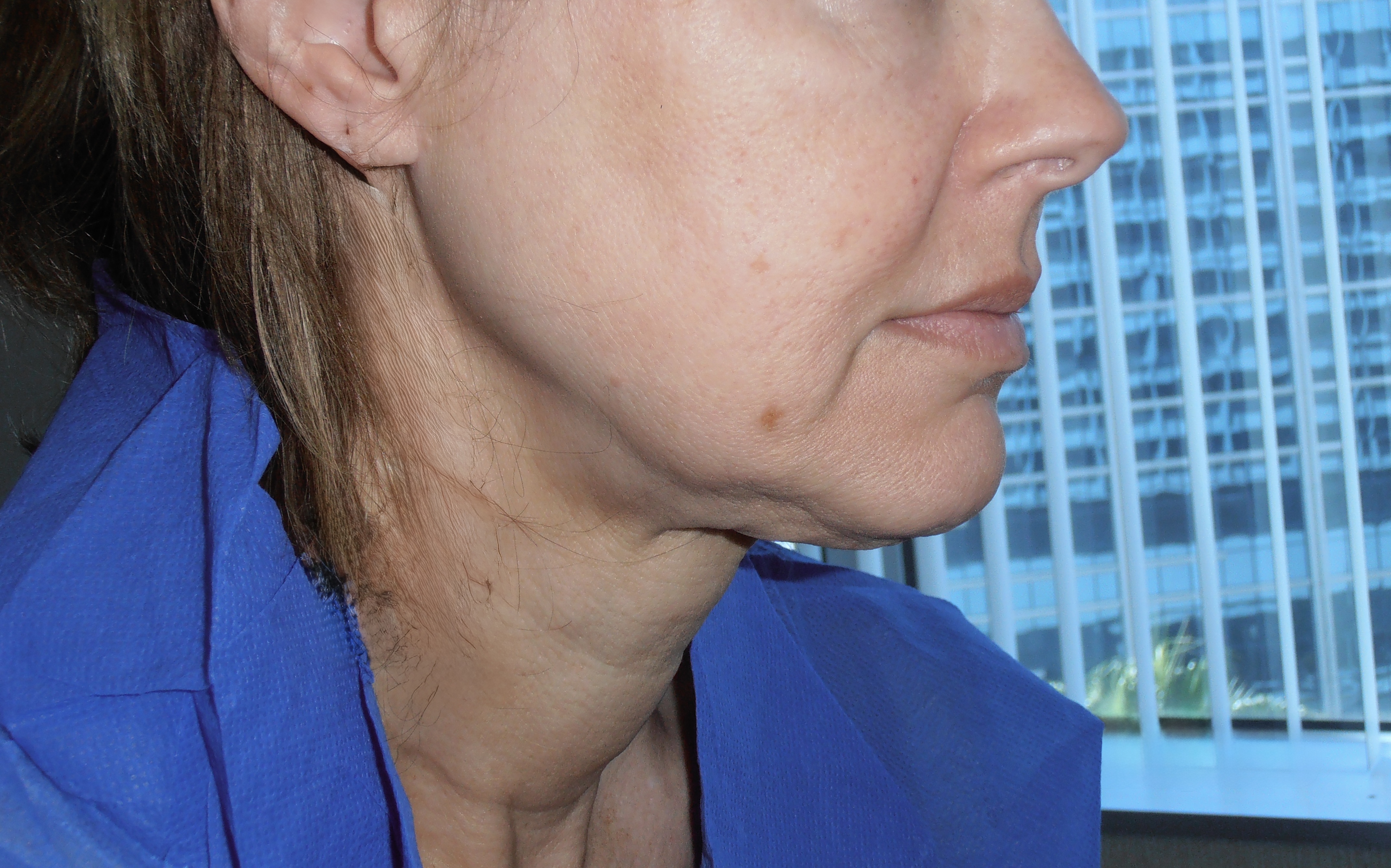 Before face and neck lift, patient 3