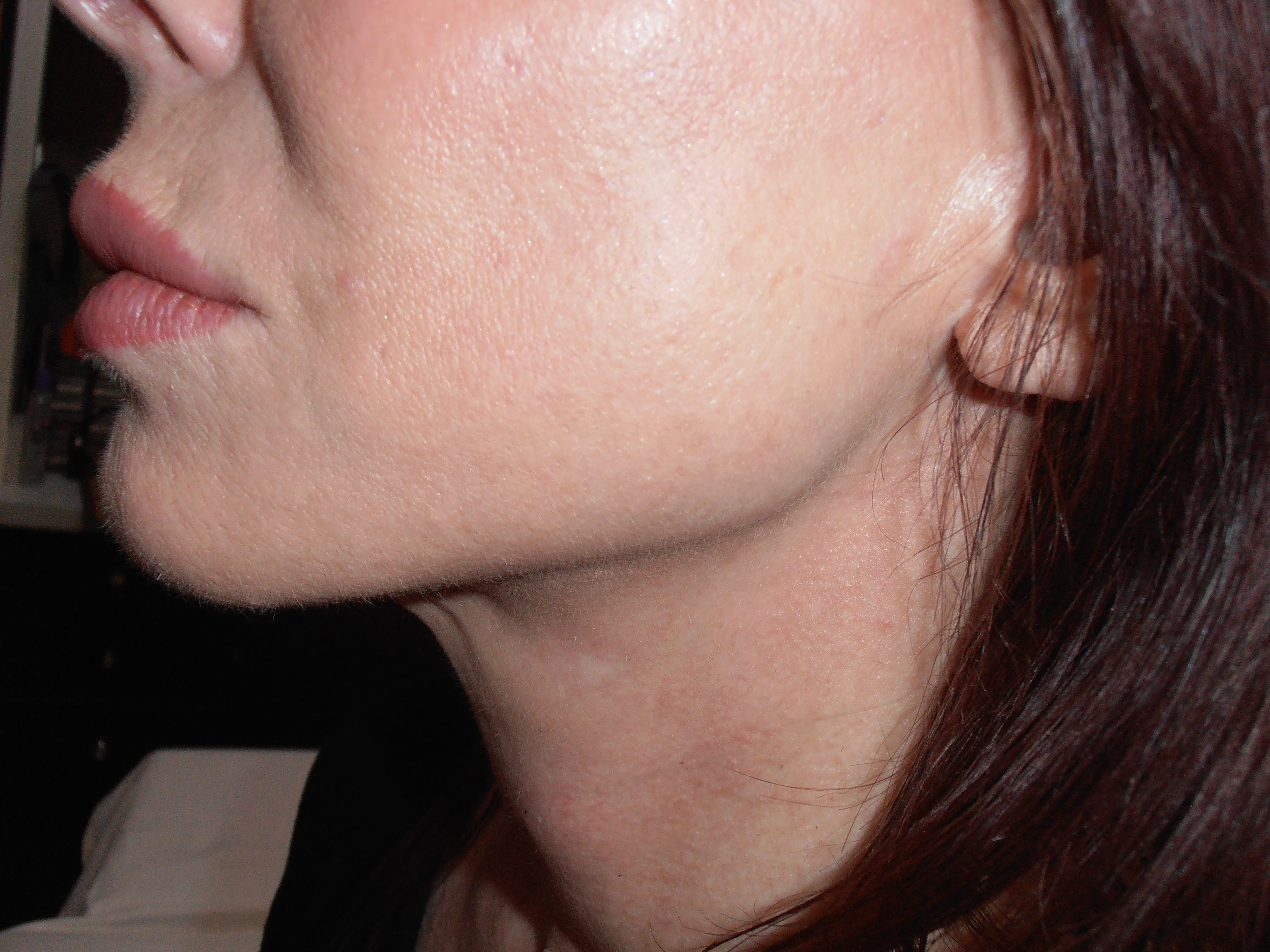 After face and neck lift, patient 20